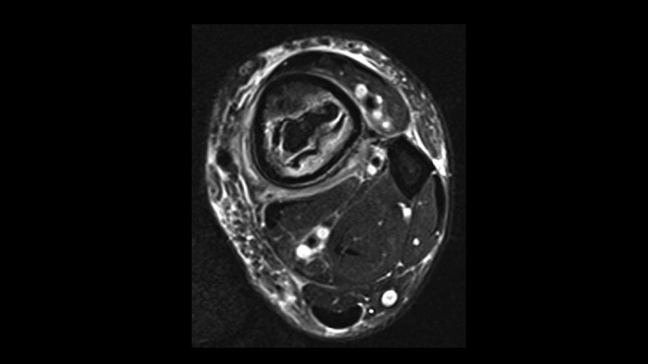 Figure 3 for case osteonecrosis ( RID5180 )
